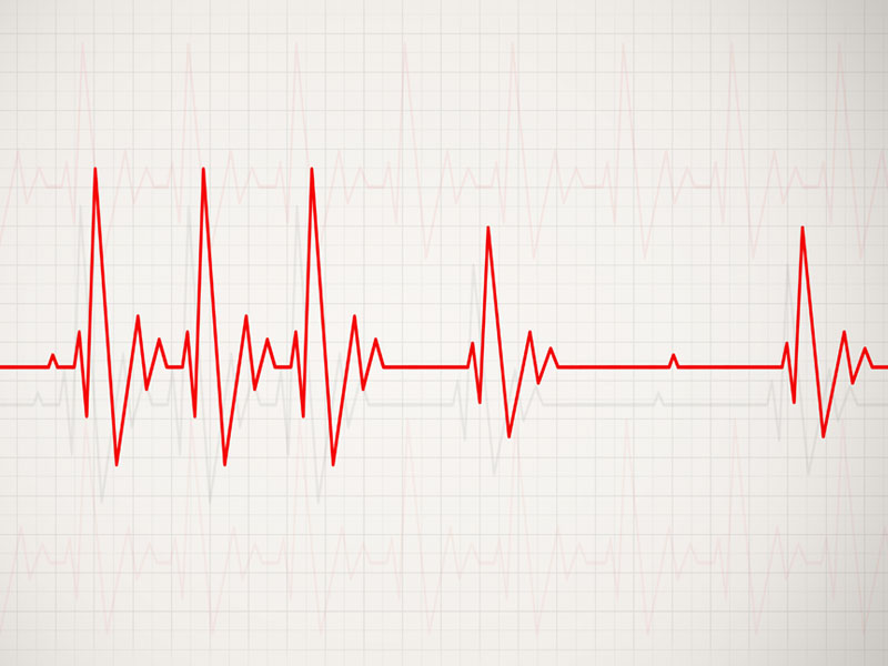 arytmia serca na wykresie