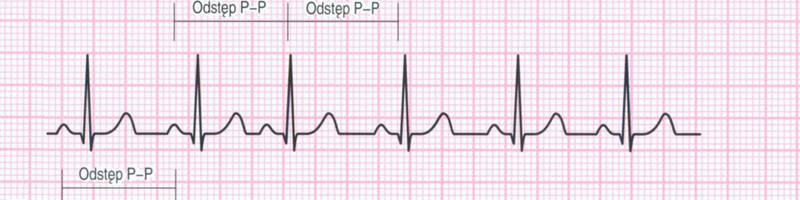 Badanie EKG - jak interpretować krzywą EKG?