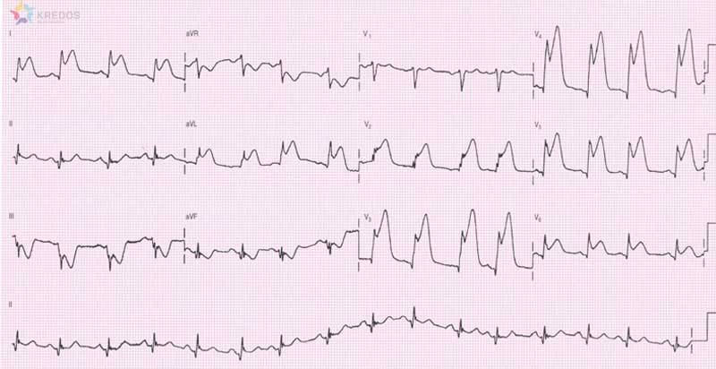 Zawał w zapisie EKG - czyli czy zawsze jest on widoczny?